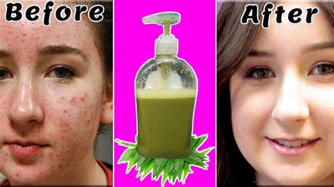 How To Remove Pimples Acne Treatment Best Home Remedy For Acne