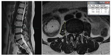 Medicina Free Full Text Severe Atrophy Of The Ipsilateral Psoas