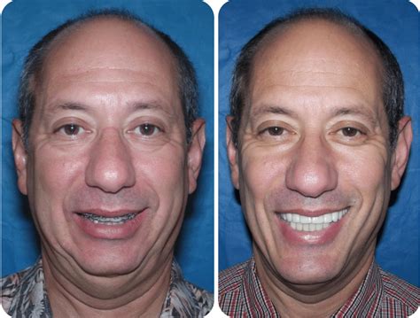 Before And After Case 2 Sleep Apnea Surgery