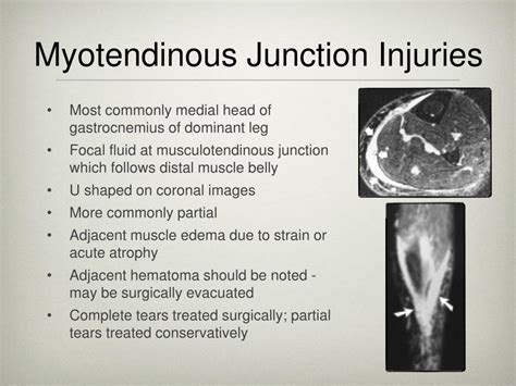 Ppt Anatomy And Pathology Of The Achilles Tendon Tracy Macnair