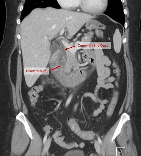 Cureus Lemmels Syndrome Secondary To Common Bile Duct Compression By