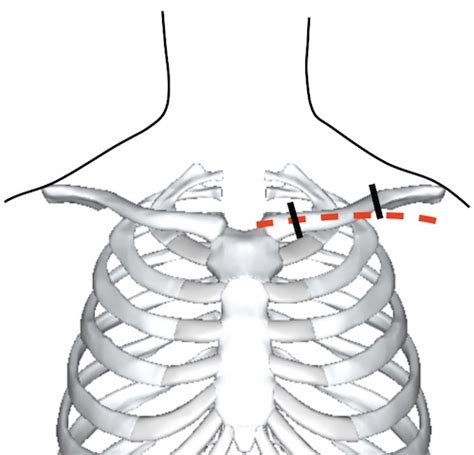 Thoracic Incisions The Operative Review Of Surgery