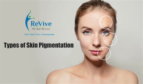 Types Of Skin Pigmentation And Skin Discoloration Disorders Revive Clinic