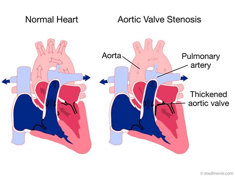 Mitral Valve Mitral Valve Or Aortic Stenosis