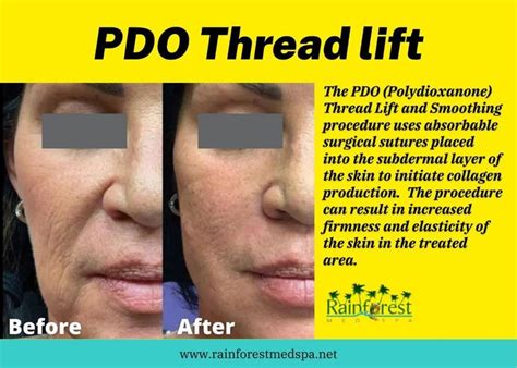 Pdo Thread Lift The Answer To Loose And Sagging Skin 🥰 Thread Lift