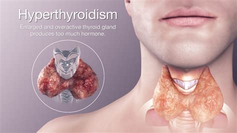 Hyperthyroidism Symptoms Causes Treatment And Diagnosis
