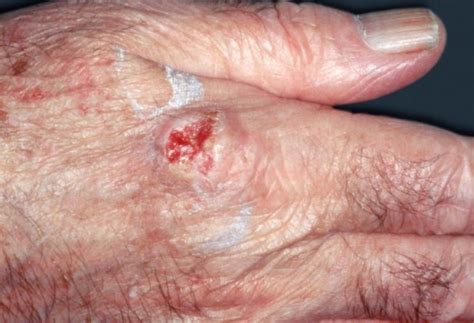 Surgery For Squamous Cell Carcinoma Reduced With Fluorouracil Cream