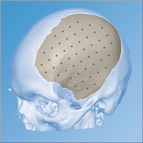 Peek Cranial Implant Milled Implant Depuy Synthes