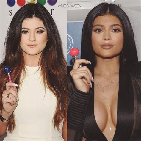 CosMediTour On Instagram Kylie Jenner S Transformation What A Stunner Kyliejenner Co