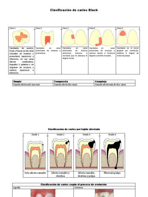 Clasificación De Caries Dental
