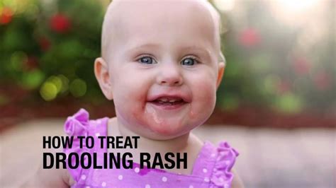Baby Drool And Teething Rash Causes Treatment And Prevention A Best Fashion