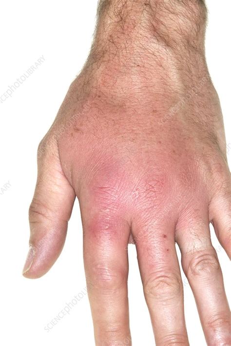 Infected Insect Bite To The Hand Stock Image C0213293 Science