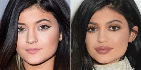 Your Ultimate Guide To Getting Lip Injections For The First Time Lip Injections Lip