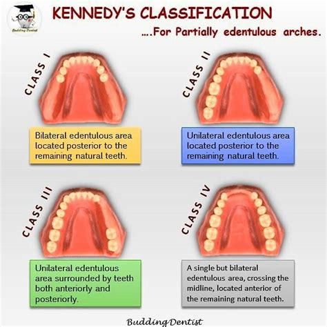 Kennedys Classification For Partially Edentulous Arches