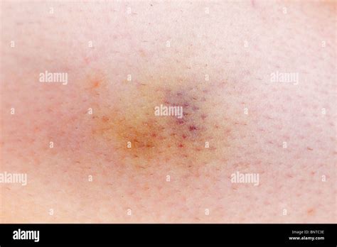 Closeup Of Large Bruise On Woman Leg Skin Stock Photo Alamy