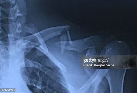 Broken Collar Bone X Ray Photos And Premium High Res Pictures Getty