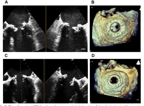 Figure 9 From Mitral Prosthetic Valve Assessment By Echocardiographic