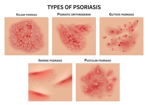Psoriasis Symptoms Causes And Treatment Affiliated Dermatology