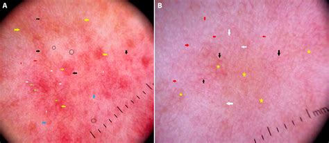 Dermoscopic Monitoring Of Response To Intense Pulsed Light In Rosacea