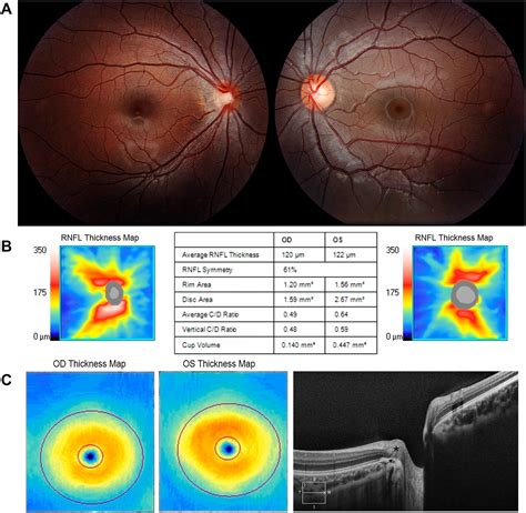 The Pseudo Hypoplastic Myopic Optic Disc Ophthalmology