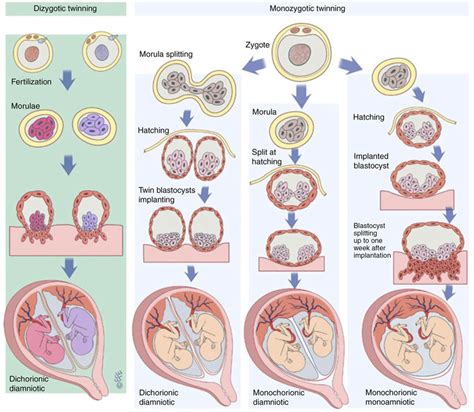 The Formation Of Dizygotic And Monozygotic Twins Dizygotic Twins Are