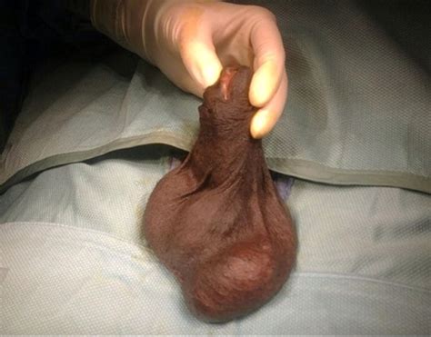 An Epidermoid Cyst Presenting As Testicular Torsion In A Patient With
