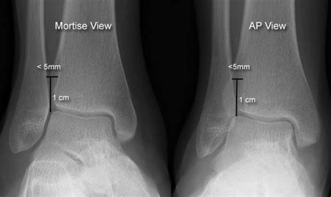 Ankle Fractures Trauma Orthobullets