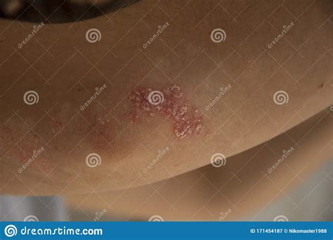 Skin Disease On The Elbow Of A Young Girl Psoriasis Eczema Or