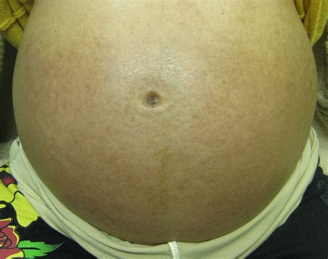 Pruritic Urticarial Papules And Plaques Of Pregnancy Wholly Abated With