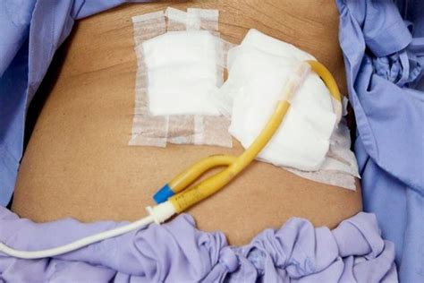 Sonda De Gastrostomia Cuidados E Funcionalidade Dicas De Enfermagem