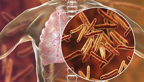 We hope the world will emerge from this tuberculosis (tb) is a global disease, found in every country in the world. Tuberculosis (TB): Risk Factors