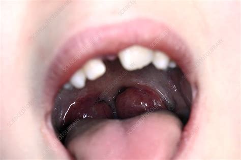Enlarged Tonsils In A Child Stock Image C0166867 Science Photo