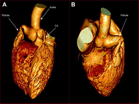 Giant AortoRight Ventricular Fistula With Single Coronary Artery