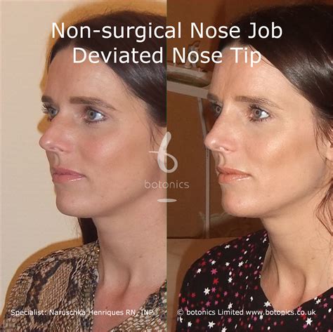 Non Surgical Nose Job Before After Photos Comparison In London UK