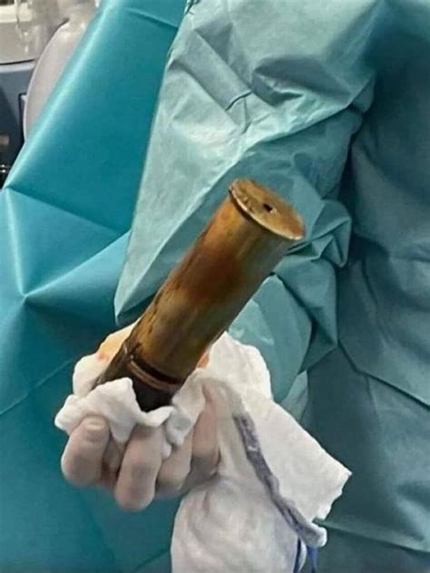Man With Wwi Explosive Lodged In His Rectum Sparks Bomb Scare Hospital