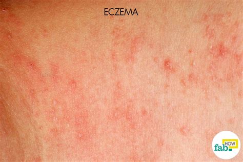 How To Get Rid Of Eczema Cure That Works Fab How