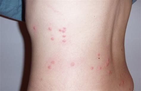 flea bites vs bed bug bites symptoms treatment pictures home remedies