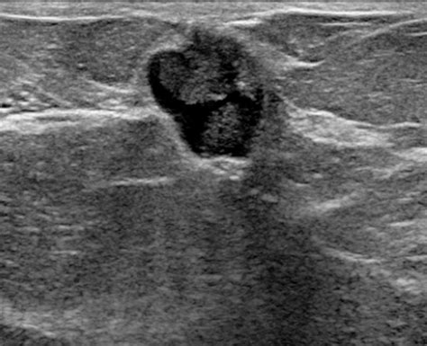 Us Appearance Of Ductal Carcinoma In Situ Radiographics