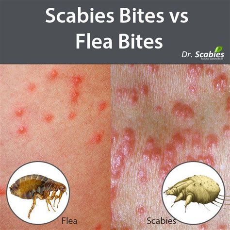 Concept Of Flea Bites Vs Bed Bugs On Humans Waridsmarttune