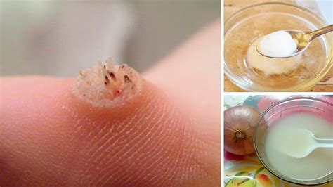 How To Get Rid Of Warts Naturally Youtube