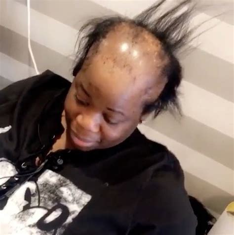This Woman With Alopecia Just Got The Most Amazing Hair Transformation