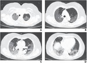 Ct Scans Of Coronavirus Patients Reveal Nature And Extent Of Lung Damage