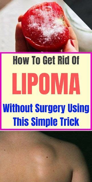 How To Get Rid Of Lipoma Without Surgery Using This Simple Trick