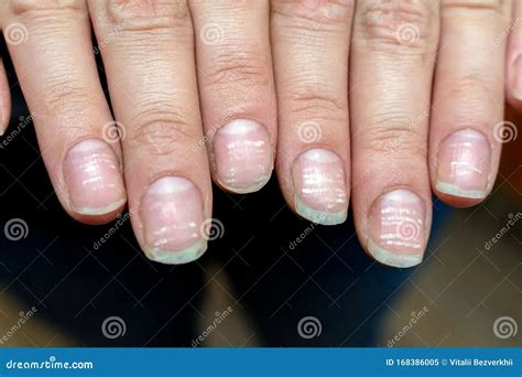 Incredible White Lines On Nails Anemia References Fsabd42