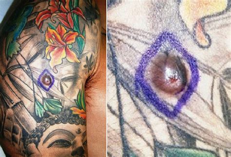 Improvement should occur within 2 to 4 weeks of treatment. Tattoo Skin Reactions: Allergies, Infections, and Burns