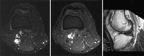 Recurrent Intraneural Ganglion Cyst Of The Tibial Nerve In Journal Of