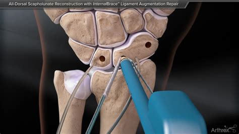 Arthrex All Dorsal Scapholunate Reconstruction With InternalBrace Ligament Augmentation Repair