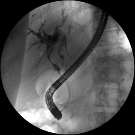 Fluoroscopy Image Of Biliary Stricture On Ercp Revealing Download