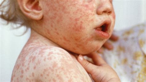 Measles Cases Approaching Highest Level In Almost 2 Decades