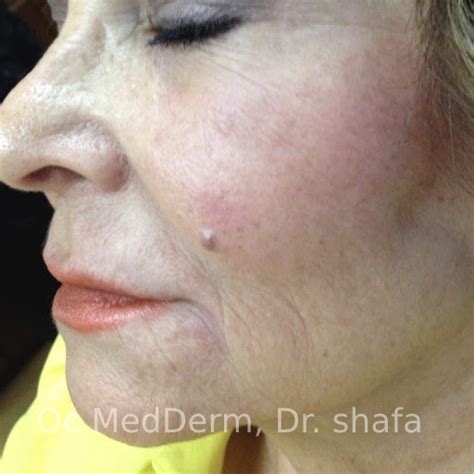 Skin Discoloration Treatment Irvine And Orange County Oc Medderm